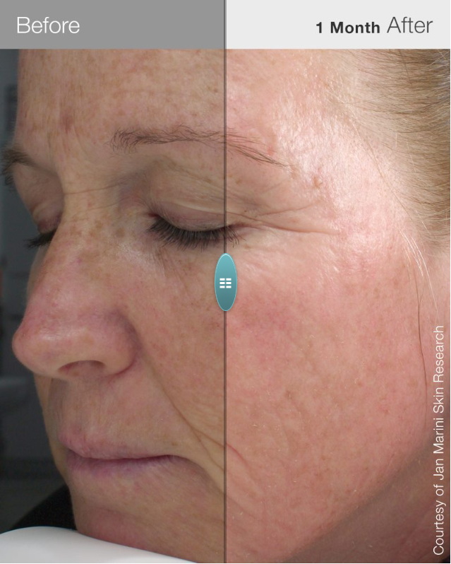 Before and After - Fine Lines and Wrinkles