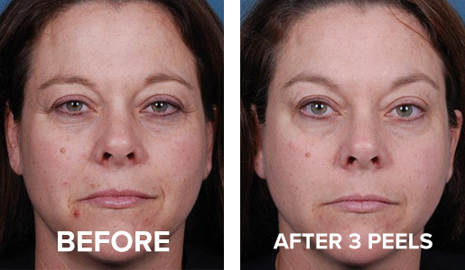 Before and After image using Blue Peel RADIANCE