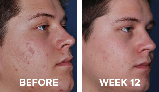 Before and After image using CLENZIderm