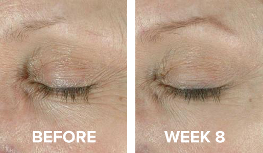 Before and After image using ELASTIderm