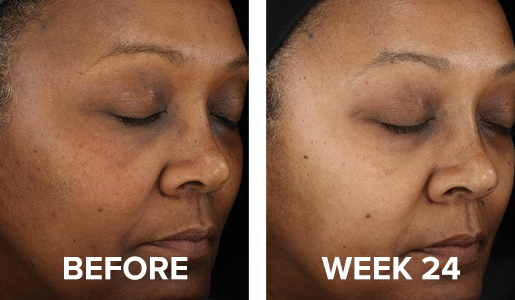 Before and After image using Nu-Derm